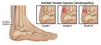 Achilles Tendon Physiotherapy